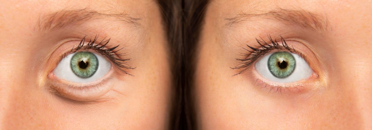 botox-eyes
