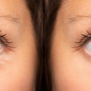 botox-eyes