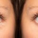 botox-eyes