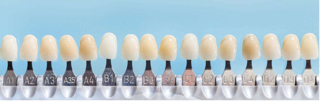 dental-veneers