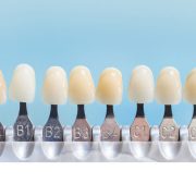 dental-veneers