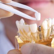 Dental Implant Revolution