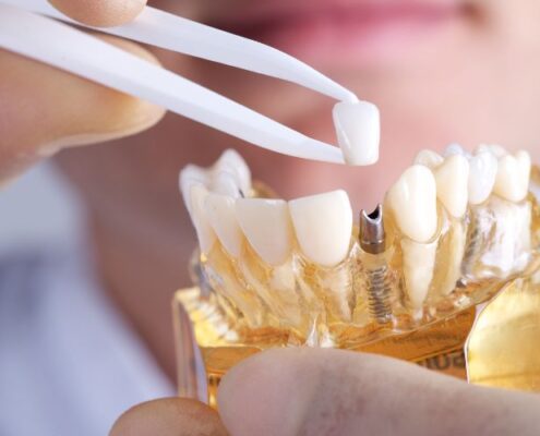Dental Implant Revolution