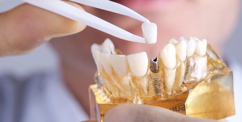 Dental Implant Revolution