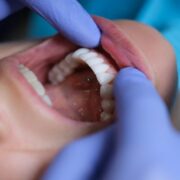 Understand Oral Cancer - University Family Dental