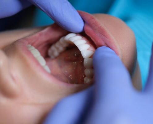 Understand Oral Cancer - University Family Dental