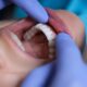 Understand Oral Cancer - University Family Dental