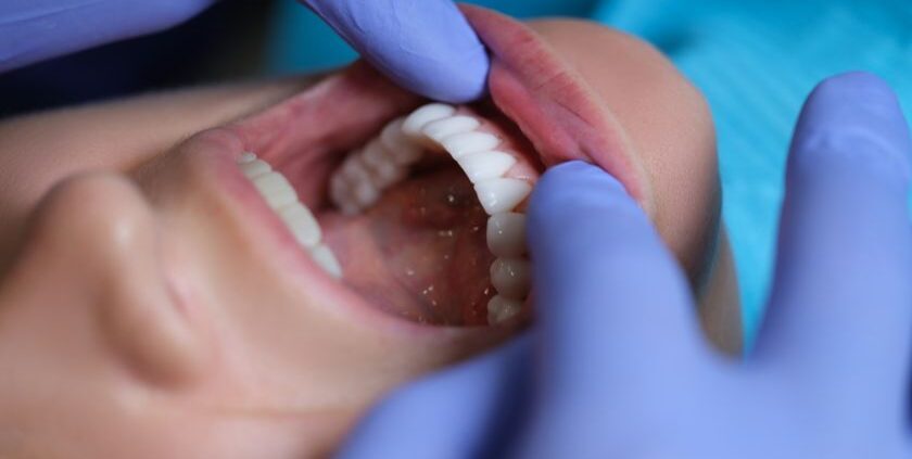 Understand Oral Cancer - University Family Dental