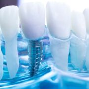 Dental Implants Las Cruces