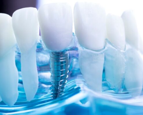 Dental Implants Las Cruces