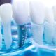 Dental Implants Las Cruces