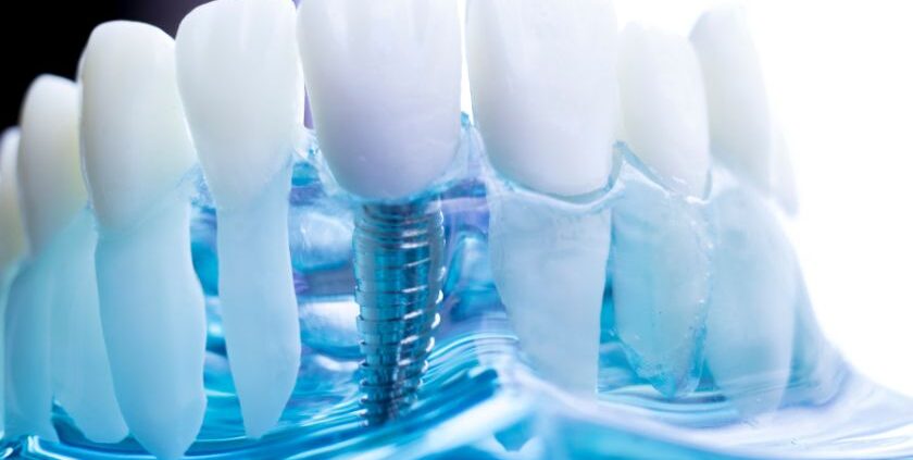 Dental Implants Las Cruces