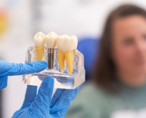 Dental Implants Las Cruces