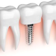 Dental Implants-University Family Dental