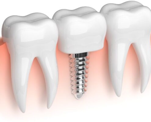 Dental Implants-University Family Dental