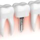 Dental Implants-University Family Dental