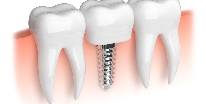 Dental Implants-University Family Dental