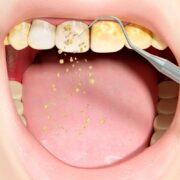 Periodontal Disease Treatment Las Cruces