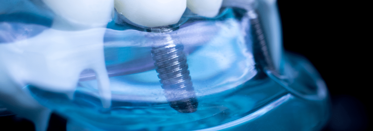 Dental Implants and Beyond: Discover the Hidden Benefits You Didn’t Know About