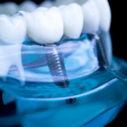 Dental Implants and Beyond: Discover the Hidden Benefits You Didn’t Know About