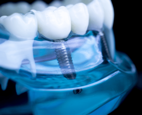 Dental Implants and Beyond: Discover the Hidden Benefits You Didn’t Know About