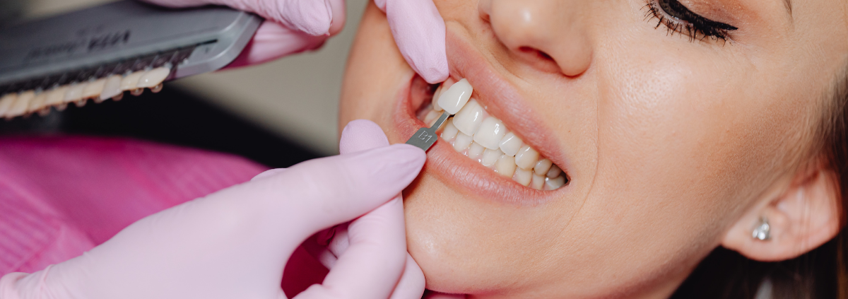 Are Veneers in Las Cruces the Secret to Achieving Your Dream Smile