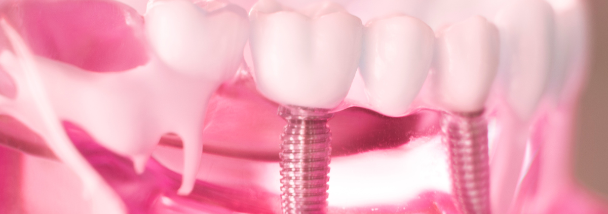 How Dental Implants in Las Cruces Can Help You Achieve a Perfectly Aligned Smile