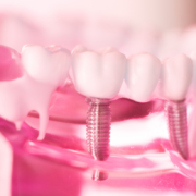 How Dental Implants in Las Cruces Can Help You Achieve a Perfectly Aligned Smile