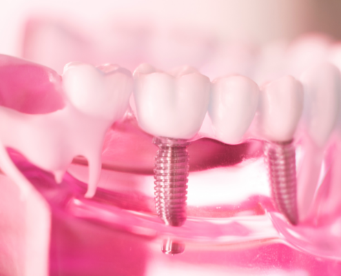 How Dental Implants in Las Cruces Can Help You Achieve a Perfectly Aligned Smile