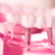 How Dental Implants in Las Cruces Can Help You Achieve a Perfectly Aligned Smile