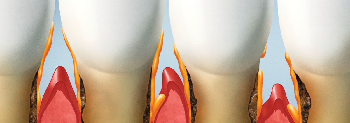 The Hidden Dangers of Periodontal Disease and Effective Treatments