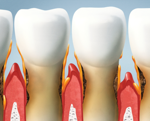 The Hidden Dangers of Periodontal Disease and Effective Treatments