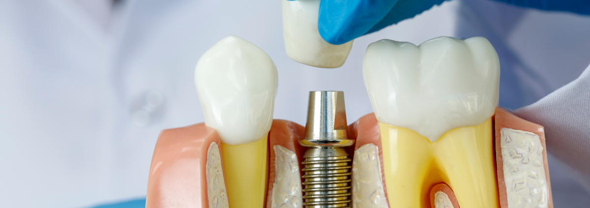 How Nutrition Impacts Dental Implant Healing and Longevity