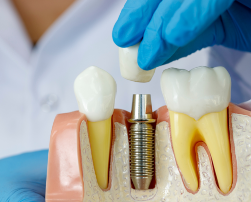 How Nutrition Impacts Dental Implant Healing and Longevity