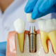 How Nutrition Impacts Dental Implant Healing and Longevity