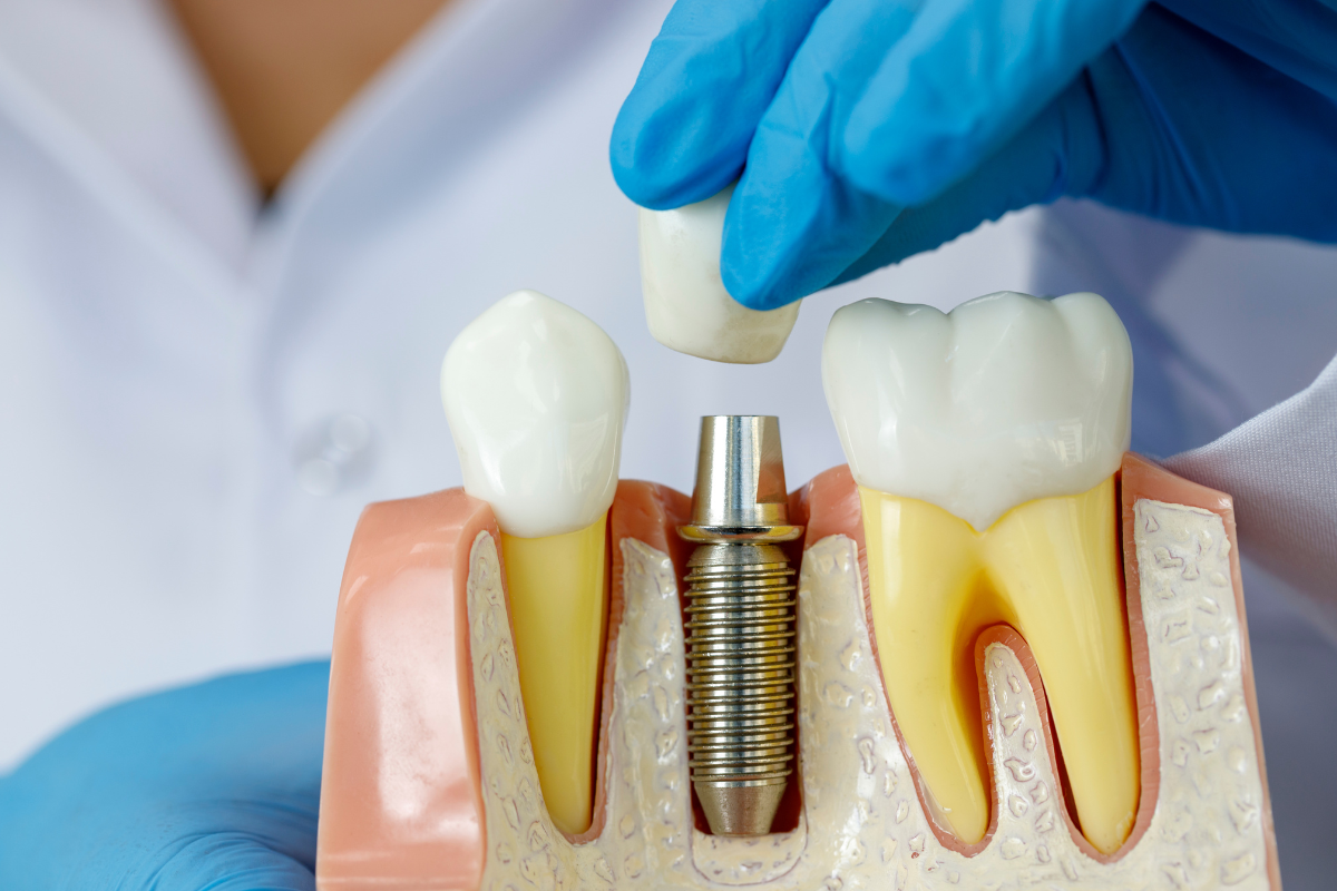 How Oral Hygiene Affects Dental Implant Longevity in Las Cruces