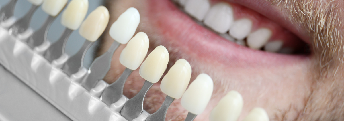 Can Veneers Be Whitened? Tips for a Bright Smile