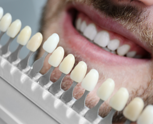 Can Veneers Be Whitened? Tips for a Bright Smile