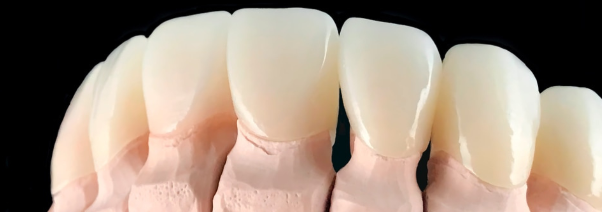 Do Veneers Ruin Your Teeth? Answered by our Las Cruces dentist