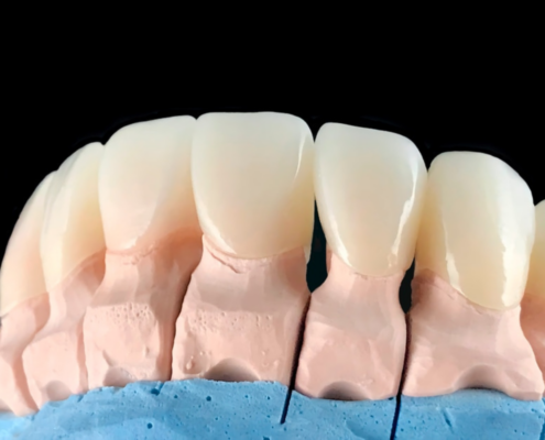 Do Veneers Ruin Your Teeth? Answered by our Las Cruces dentist