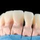 Do Veneers Ruin Your Teeth? Answered by our Las Cruces dentist