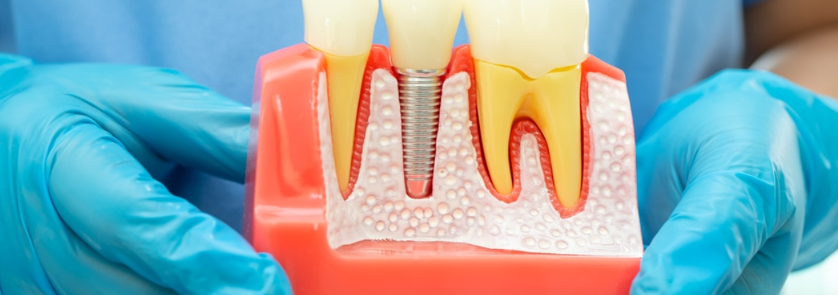 Can I Get a Dental Implant After a Root Canal?