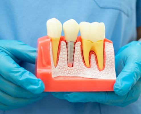 Can I Get a Dental Implant After a Root Canal?