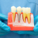 Can I Get a Dental Implant After a Root Canal?