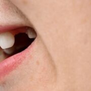 Close-up of a person's smile showing a missing upper tooth gap.