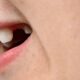 Close-up of a person's smile showing a missing upper tooth gap.